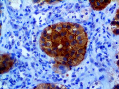 IHC of NRAS on an FFPE Melanoma Tissue